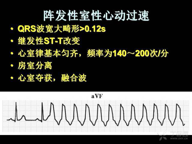 阵发性室上性心动过扑，让人头疼的心跳乱跳