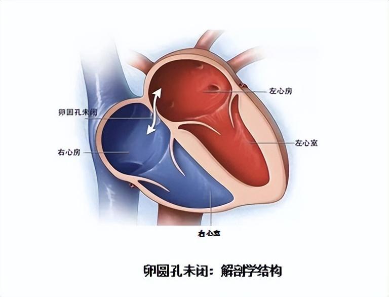 卵圆孔未闭3mm严重吗_卵圆孔未闭3.1mm严重吗_卵圆孔未闭3mm怎么办