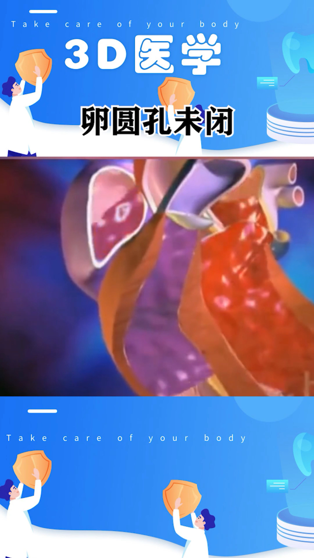 卵圆孔未闭3.1mm严重吗_卵圆孔未闭3mm严重吗_卵圆孔未闭3mm怎么办