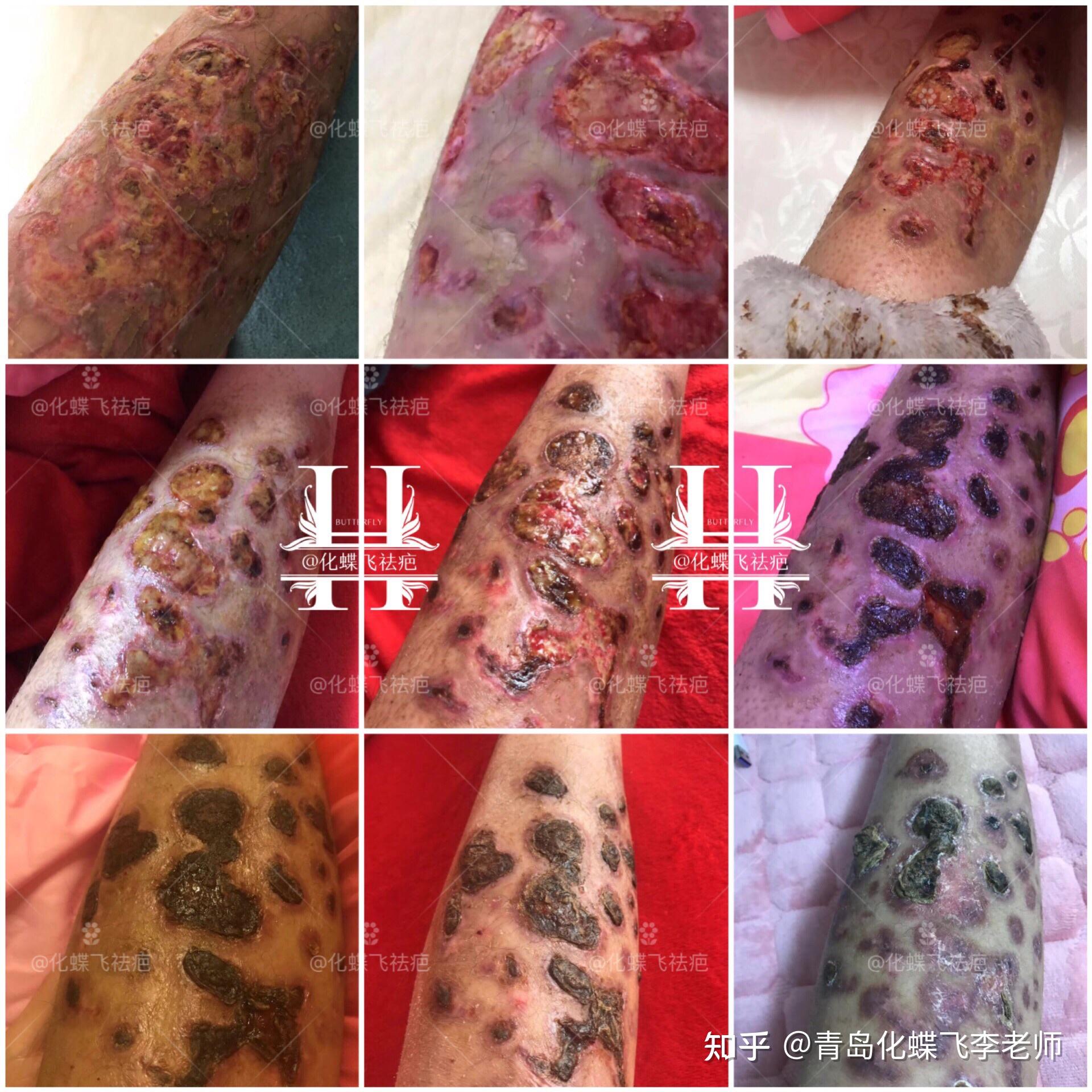 结痂洗澡可以吗_伤口结痂可以洗澡吗_结痂能洗澡